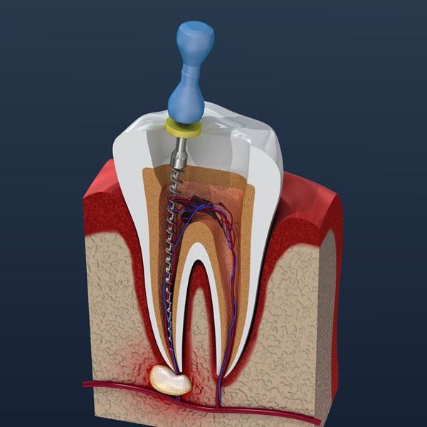 Do Dentists Lie About Root Canals 